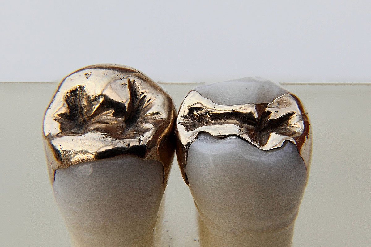 Gold use for dental inlays