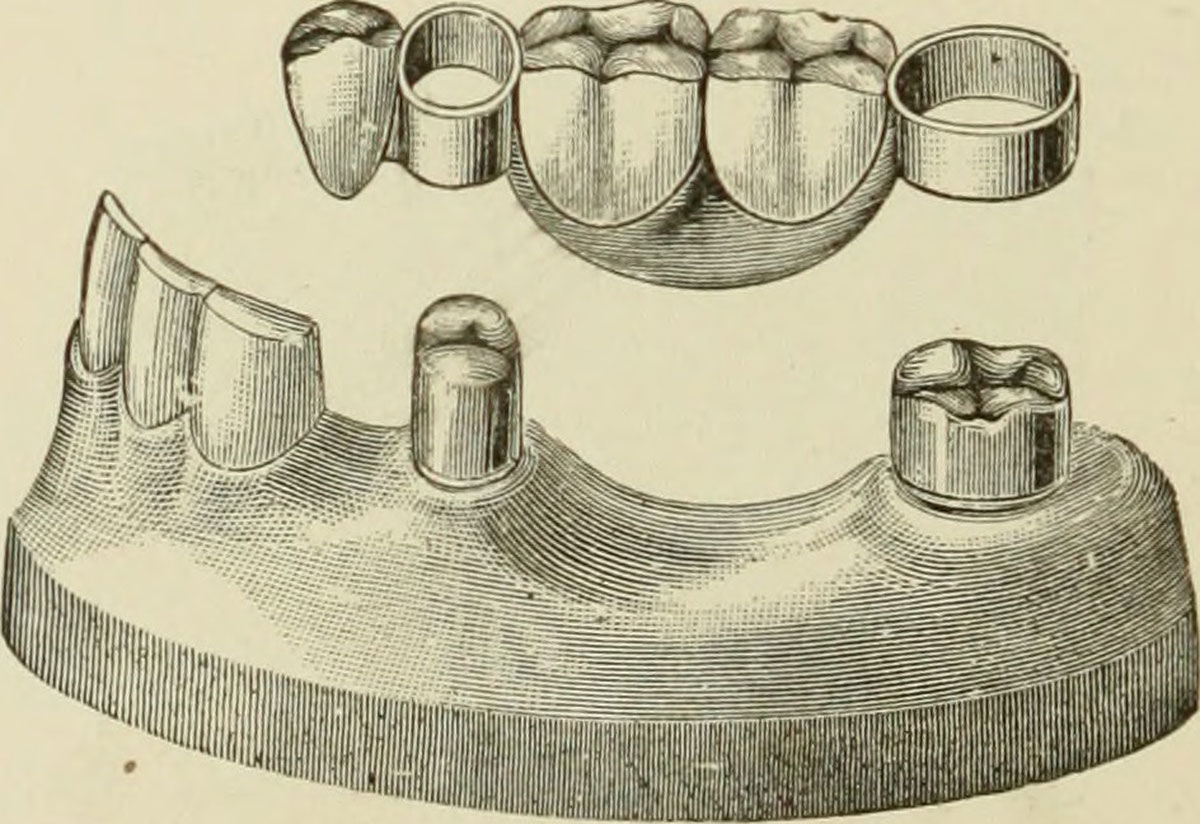 gold in dentistry :artifical crown and bridge work from 1889